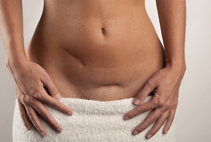 A woman rests her hands on her hip bones, showing two surgical scars on her stomach.