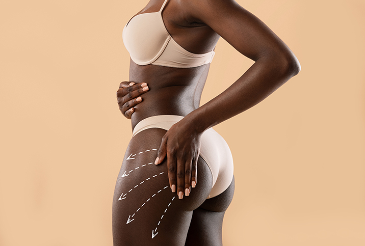A woman poses with her hand against the side of her rear and arrows leading down her thigh.