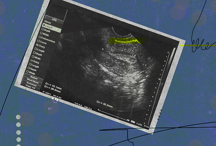 An endometrial stripe is highlighted in yellow on an ultrasound photograph.