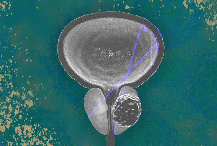 A grey prostate sits against a green background.
