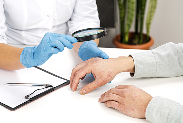 A doctor holds up a magnifying glass to a patient's hand showing a skin condition.