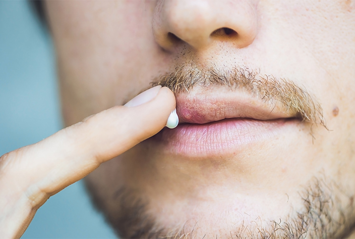 A man is putting white ointment onto his lips.